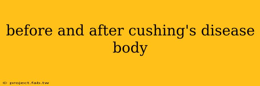 before and after cushing's disease body