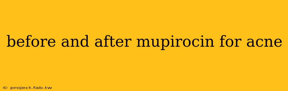 before and after mupirocin for acne