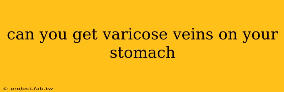 can you get varicose veins on your stomach